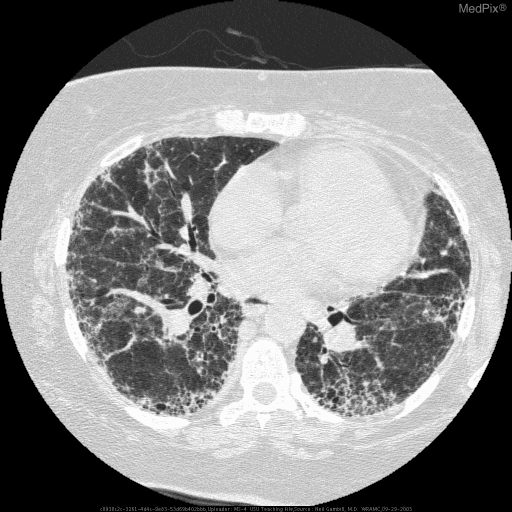 **Imaging Modality:** High-resolution computed tomography (HRCT) of the chest, axial section.