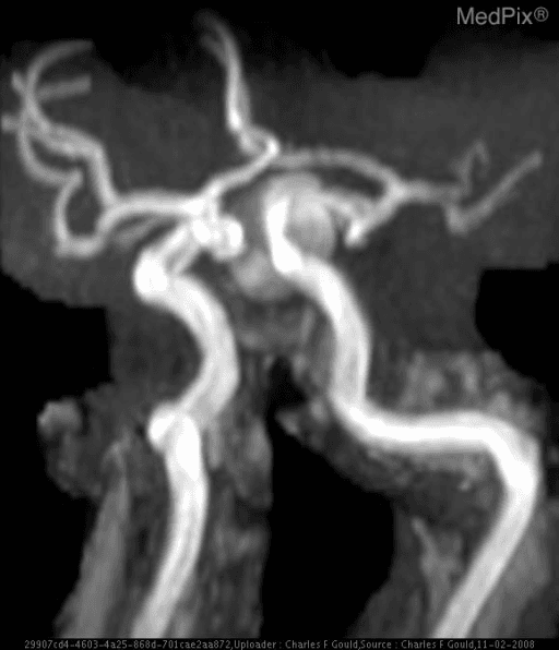 **Imaging Modality:** Magnetic Resonance Angiography (MRA) with 3D reconstruction (likely Time-of-Flight/TOF technique).