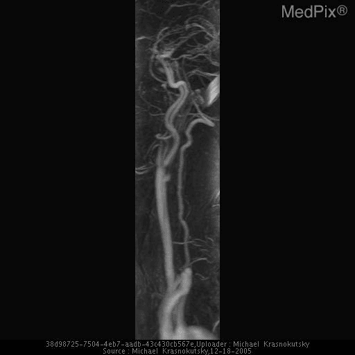 **Imaging Modality:** Magnetic Resonance Angiography (MRA) maximum intensity projection (MIP) image.
**Anatomical Region:** Cervical region focusing on the posterior cerebral circulation.
**Observed Pathology:** The image demonstrates the course of the vertebral artery. Clinical context suggests rotational vertebral artery occlusion, also known as Bow Hunter’s syndrome. This condition is characterized by mechanical compression of the vertebral artery during head rotation.
**Characteristic Visual Features:**
- A longitudinal view of the vertebral artery ascending through the cervical spine.
- The vessel exhibits its characteristic tortuous course as it approaches the atlanto-axial (C1-C2) segment.
- Potential narrowing or signal dropout is typically localized at the level of the C1-C2 joint, where the artery exits the foramen transversarium and travels over the posterior arch of the atlas.
**Key Diagnostic Features:** The image highlights the V2 (foraminal) and V3 (extraspinal) segments of the vertebral artery. In the context of Bow Hunter’s syndrome, the primary finding is dynamic stenosis or occlusion triggered by physiological neck rotation, frequently secondary to osteophytic compression or ligamentous hypertrophy at the C1-C2 level.
