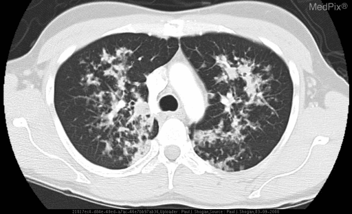 **Imaging Modality:** Contrast-enhanced axial Computed Tomography (CT) of the chest, displayed in lung window settings.
**Anatomical Region:** Upper thoracic cavity at the level of the aortic arch and tracheal bifurcation.
**Observed Pathology:** The image demonstrates bilateral, symmetric, and patchy-to-confluent air space opacities. The distribution is predominantly central and perihilar within the upper lung lobes. These findings are characterized by ground-glass attenuation and consolidation with ill-defined borders.
**Characteristic Visual Features:**
- **Air Bronchograms:** Visible within the areas of confluent consolidation.
- **Distribution:** Central/perihilar "bat-wing" pattern with relative sparing of the extreme peripheral/subpleural lung parenchyma.
- **Associated Features:** There is an absence of significant pleural effusions or overt mediastinal lymphadenopathy at this level.
**Clinical Context:** In the setting of severe immunocompromise (HIV/AIDS with low CD4 count), these radiologic findings are highly suggestive of opportunistic infection, most notably *Pneumocystis jirovecii* pneumonia (PCP).
**Differentiating Features:** The central upper lobe predominance and lack of pleural fluid help distinguish this pattern from typical bacterial pneumonia or cardiogenic pulmonary edema.