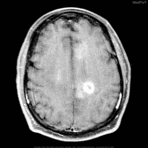 **Imaging Modality:** Axial T1-weighted post-contrast Magnetic Resonance Imaging (MRI) of the brain.