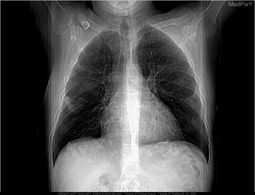 **Imaging Modality:** Posteroanterior (PA) chest radiograph (topogram/scout view).
**Anatomical Region:** Thorax, including the lungs, mediastinum, and diaphragmatic surface.
**Observed Pathology:** Multiple, discrete, calcified pleural plaques consistent with asbestos-related pleural disease.
**Characteristic Visual Features:**
- **Calcification:** High-attenuation, radio-opaque opacities are noted along the bilateral diaphragmatic pleura and the lateral chest walls.
- **Distribution:** The lesions are multifocal and characteristically concentrated in the mid-to-lower thoracic zones.
- **Morphology:** The plaques exhibit a "holly leaf" appearance in some areas, representing the irregular, jagged margins of calcified pleural thickening viewed en face.
- **Sparing:** There is relative sparing of the lung apices and the costophrenic angles.
**Relevant Clinical Context:** These findings are pathognomonic for chronic asbestos exposure. While the lung parenchyma appears relatively clear in this view, the presence of such extensive pleural calcification indicates a risk for underlying asbestosis (interstitial fibrosis) and increased susceptibility to bronchogenic carcinoma or malignant mesothelioma.
**Key Diagnostic Features:** Bilateral, calcified diaphragmatic and parietal pleural plaques; absence of acute pleural effusion.