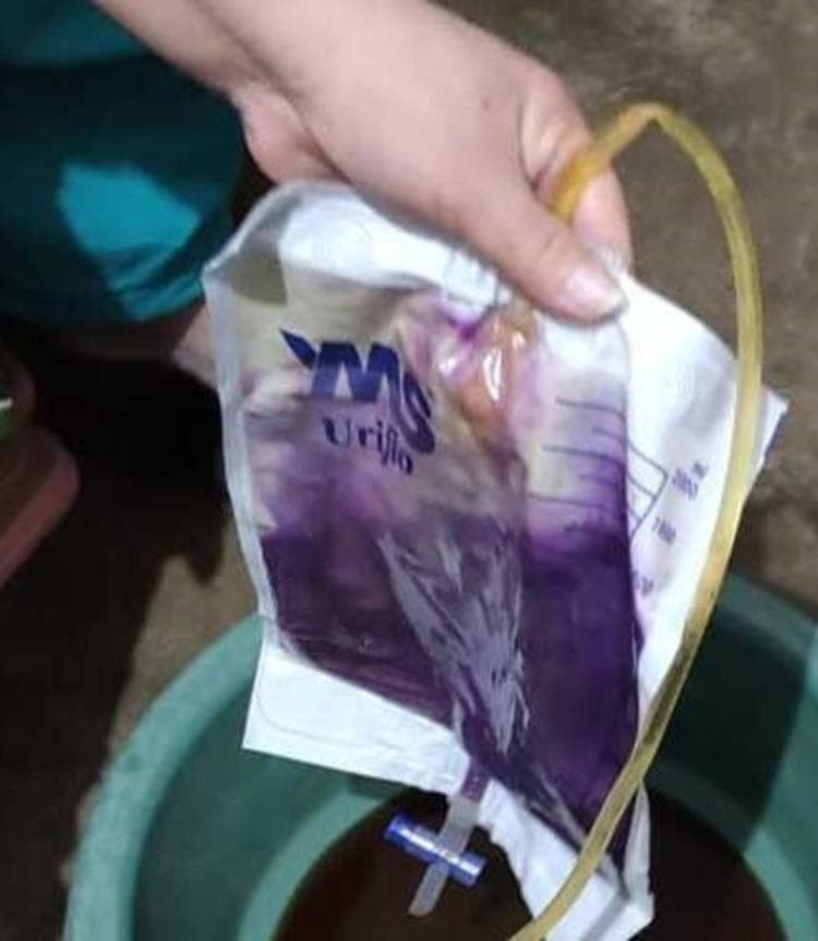 Clinical photograph illustrating Purple Urine Bag Syndrome (PUBS) in a patient with a chronic indwelling Foley catheter. The image shows a standard medical drainage bag containing urine with a distinctive, deep purple discoloration. The intensity of the pigment is most concentrated at the bottom of the bag, showing a layering effect where the color transitions to a lighter lavender and brownish-yellow tint at the top. The drainage system features a translucent, yellowish catheter tube and a blue-and-white T-tap drainage valve at the base of the graduated collection bag. This phenomenon is a rare manifestation typically associated with urinary tract infections caused by tryptophan-metabolizing bacteria (such as E. coli, Klebsiella, or Proteus species) in patients with alkaline urine and chronic constipation. The purple pigment results from the chemical reaction of indigo and indirubin, which are metabolic byproducts of dietary tryptophan, with the plastic materials of the catheter and bag.
