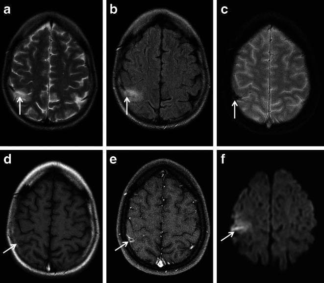 This composite diagnostic image displays six axial MRI brain sequences (a-f) of a 27-year-old female, illustrating the neuroradiological features of cortical vein thrombosis in the right postcentral parietal region. Sequence (a) T2-weighted and (b) FLAIR images demonstrate a hyperintense cortical lesion (arrows). The (c) T2*-weighted image reveals significant signal loss and a 'blooming' artifact localized to a central cortical vein, indicative of paramagnetic blood products such as deoxyhemoglobin or hemosiderin within a thrombus. The (d) pre-contrast T1-weighted image shows a subtle isointense to hypointense lesion, while (e) the post-contrast T1-weighted image exhibits circumscribed peripheral enhancement, suggesting blood-brain barrier disruption. Finally, (f) the Diffusion-Weighted Imaging (DWI) shows restricted diffusion (arrow), confirming an acute thrombus. These findings serve as a critical differential diagnostic tool to distinguish cortical vein thrombosis from cortical superficial siderosis (cSS). The presence of the tubular blooming effect and intravasal diffusion restriction are key pedagogical markers for identifying venous outflow disorders in clinical practice.