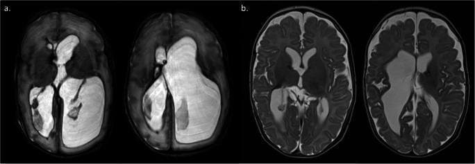 This diagnostic image displays four axial MRI brain scans of infants at term-equivalent age, categorized into two clinical scenarios (a and b) to evaluate post-hemorrhagic ventricular dilatation (PHVD). Panel (a) shows two T2-weighted axial slices demonstrating severe, asymmetric ventricular enlargement (hydrocephalus). The lateral ventricles are markedly dilated and hyperintense, causing significant compression and effacement of the surrounding brain parenchyma and cortical sulci. This appearance indicates failed management by a temporizing ventriculosubgaleal shunt (VSGS), necessitating permanent ventriculoperitoneal (VP) shunt insertion. Panel (b) shows two axial slices from a different infant where the ventricles are well-controlled and significantly smaller in volume. There is better preservation of cerebral mantle thickness and visible cortical folding (gyri and sulci), indicating successful management where the VSGS could be safely removed without permanent shunting. The comparison illustrates the use of MRI in neonatal neurosurgery to assess ventricular volume, brain tissue organization, and the clinical need for permanent cerebrospinal fluid diversion.