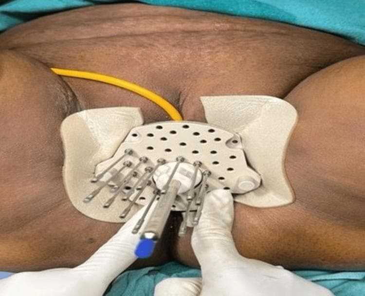 Clinical photograph of a patient undergoing high-dose-rate (HDR) interstitial brachytherapy for recurrent cervical cancer. The image shows a Kelowna template applicator secured over the perineal/vaginal region. Multiple thin, metallic interstitial needles are inserted through the circular grid of the applicator into the underlying tissue, arranged in a radial configuration to target the vaginal vault and paracervical regions. A Foley catheter (yellow) is visible, indicating bladder drainage during the procedure. The foreground shows a healthcare provider's gloved hands manipulating a central applicator component. This clinical setup demonstrates the surgical application of template-based interstitial brachytherapy, which allows for precise three-dimensional dose distribution in patients where conventional intracavitary brachytherapy is insufficient due to tumor anatomy or recurrence.