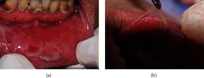 Two-panel clinical photograph illustrating severe oral manifestations of Pemphigus Vulgaris. Panel (a) shows the lower labial and gingival mucosa with extensive erythematous erosions, postbullous ulcerations, and sloughing tissue. The lesions exhibit a raw, inflamed appearance with irregular borders and whitish fibrin deposits. Visible mandibular teeth demonstrate significant plaque accumulation and poor oral hygiene. Panel (b) demonstrates a positive Nikolsky sign, a hallmark of autoimmune bullous diseases. Under tangential pressure, the superficial epithelium is being peeled away from the underlying basement membrane, creating a thin, translucent flap. This finding visually confirms acantholysis and the extreme fragility of epithelial attachment mechanisms. The images highlight the diagnostic physical exam findings in a 55-year-old patient with systemic vesiculobullous disease, emphasizing the transition from intact blisters to painful mucosal erosions.