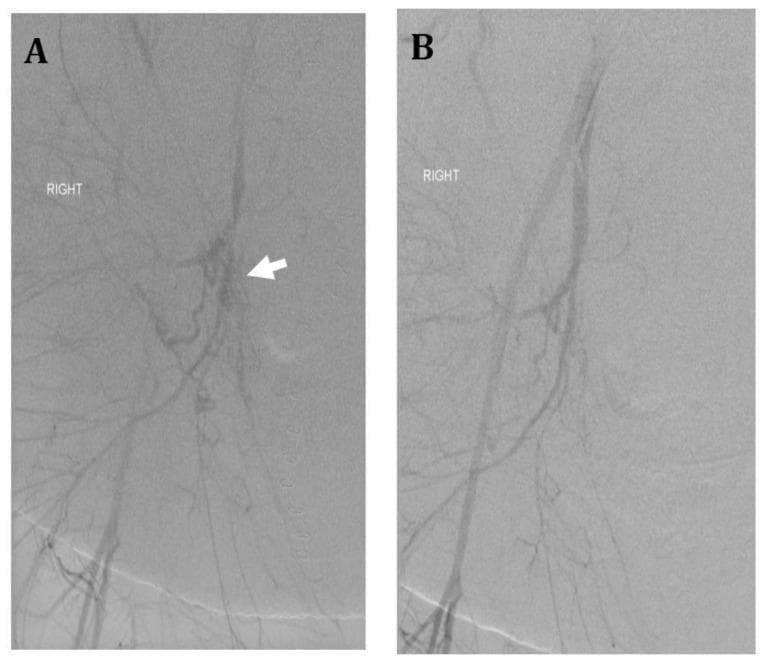 This diagnostic image set consists of two panels (A and B) showing catheter-based digital subtraction angiography (DSA) of the right internal iliac artery in a 36-year-old female patient with placenta accreta and postpartum hemorrhage. Panel A (Pre-embolization): The angiogram demonstrates the right pelvic vasculature with a focus on the internal iliac artery. A white arrow points to a distinct area of hypervascularity characterized by a dense cluster of multiple irregular, tortuous, and small-caliber vessels, consistent with pathological neovascularization or extravasation in the setting of retained placenta. Panel B (Post-embolization): Following the administration of Gelfoam into the anterior division of the internal iliac artery, a repeat angiogram shows successful devascularization of the previously identified abnormal vessels. There is a notable absence of the irregular vascular cluster and any signs of active extravasation, while the primary proximal arterial branches remain patent. This comparison illustrates the use of uterine artery embolization (UAE) as an emergency interventional radiology procedure for hemodynamic stabilization and hemorrhage control.