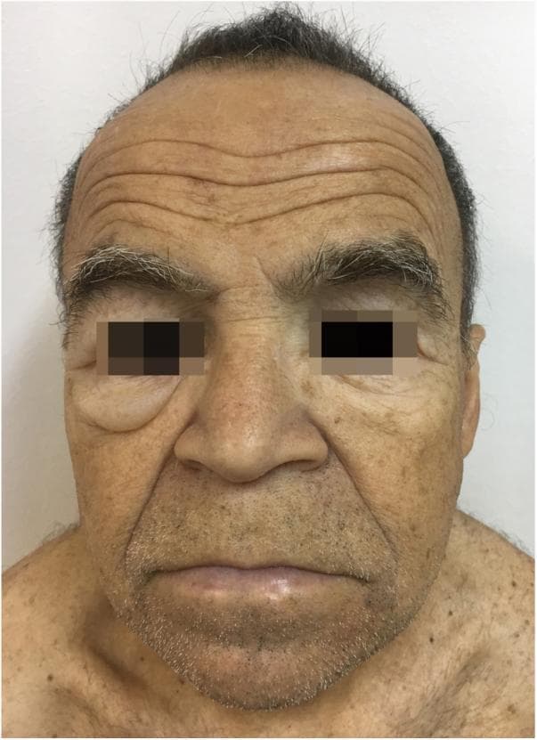 A clinical photograph displaying the frontal view of a 58-year-old male exhibiting classic signs of myxedematous facies associated with primary hypothyroidism. Notable features include bilateral periorbital edema, most pronounced in the right lower eyelid, which appears as a soft, fluid-filled swelling. The patient presents with generalized facial puffiness, particularly around the mid-face and jawline, contributing to a characteristic 'moon-like' facial contour. The skin demonstrates a yellowish, pale tonality (pallor) and a dry texture consistent with xeroderma. Additional visible findings include deep forehead wrinkling, significant skin laxity in the lower facial region, and sparse lateral eyebrows. This image serves as a clinical illustration of the cutaneous and soft tissue manifestations of severe thyroid hormone deficiency, illustrating the accumulation of glycosaminoglycans in the dermis.
