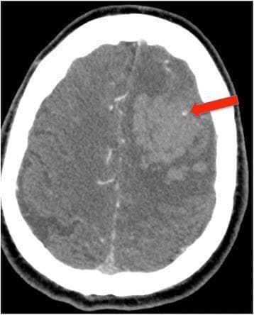This diagnostic image is an axial Computed Tomography Angiography (CTA) scan of the brain demonstrating an acute spontaneous intracerebral hemorrhage (ICH). A large, hyperdense, heterogeneous hematoma is visible within the left cerebral hemisphere, exerting a mild mass effect. A prominent clinical feature, indicated by a red arrow, is the 'spot sign,' which appears as a small, focal area of contrast enhancement or extravasation within the hematoma itself. In emergency neurology and neuroradiology, the CTA spot sign is a significant radiographic marker used to predict an increased risk of hematoma expansion, poor functional outcomes, and higher mortality rates. The image serves as a key educational example of acute vascular disruption and ongoing bleeding within a primary hemorrhagic stroke, highlighting the utility of CTA in the initial stabilization and prognostic assessment of ICH patients.