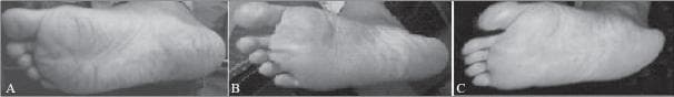 This sequence of grayscale clinical photographs serves as a comparison chart illustrating the dermatological progression of a human foot undergoing topical treatment for xerosis and hyperkeratosis. Image A (Day 0) demonstrates the baseline clinical condition of the plantar surface, characterized by deep skin fissures (heel cracks), prominent epidermal ridges, and a dry, rough texture indicative of compromised barrier function. Image B (after 4 weeks) shows intermediate progression, with a visible reduction in the depth and severity of the fissures and a softening of the skin texture. Image C (after 8 weeks) displays the therapeutic outcome, showcasing a significant resolution of the cracks and restoration of a smooth, hydrated appearance with reduced visibility of lines. This visual timeline is representative of clinical efficacy studies in podiatry and dermatology, focusing on skin regeneration, emolliency, and the repair of cracked heels using therapeutic foot care formulations.