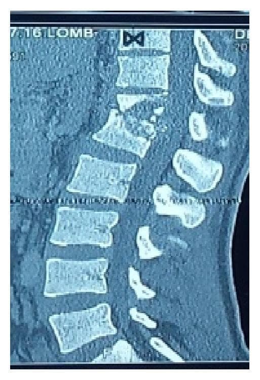 This diagnostic image is a sagittal Computed Tomography (CT) scan of the thoracolumbar spine demonstrating advanced tuberculous spondylitis (Pott's disease). The scan shows significant osteolysis and bone destruction localized to the D12 and L1 vertebral bodies. Key pathological features include the collapse of these vertebral segments and the loss of the normal intervertebral disc space. This structural failure has resulted in a marked focal kyphotic deformity (Gibbus deformity) of approximately 40 degrees, which indicates severe spinal instability and possible cord compression. There is evidence of perilesional osteosclerosis surrounding the lytic areas, reflecting a chronic inflammatory and reactive healing process. The image serves as a classic educational example of spinal tuberculosis, illustrating the progression from disc space infection to vertebral destruction and subsequent spinal malalignment.
