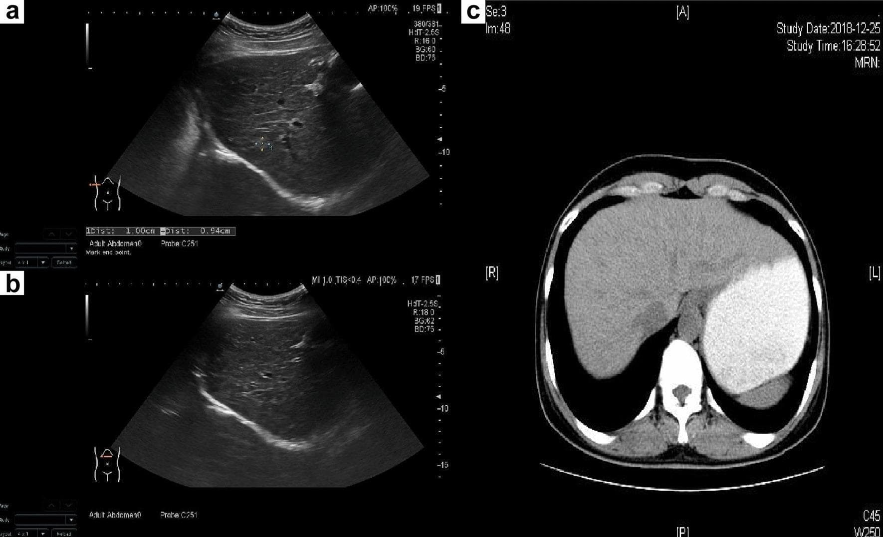 This composite diagnostic image showcases the liver's appearance in early cirrhosis using two imaging modalities: abdominal ultrasound (panels a and b) and axial CT (panel c). The grayscale abdominal ultrasounds demonstrate a liver with an unsmooth surface and irregular margins. The parenchyma exhibits increased echogenicity with thickened, dot-like echoes and a coarse, uneven texture. Small, slightly hyperechoic nodules are dispersed throughout the liver tissue, representing early regenerative changes. The axial CT scan of the upper abdomen (panel c) reveals a distinctive wavy or nodular hepatic capsule, further indicating structural remodeling. Notable clinical findings include the absence of ascites and the exclusion of fatty liver or venous thromboembolism. These visual features are characteristic findings of early-stage liver cirrhosis, likely related to metabolic etiologies such as Wilson's disease, as indicated by the patient's genetic and biochemical context. This educational content is suitable for radiology and gastroenterology residents learning the morphological signs of chronic liver disease.