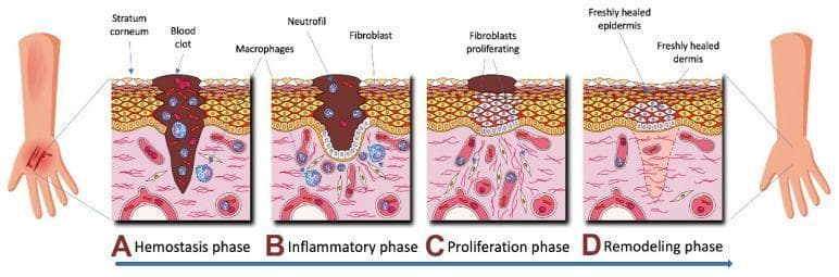 A medical pathophysiology diagram illustrating the four sequential phases of human skin wound healing: Hemostasis (A), Inflammation (B), Proliferation (C), and Remodeling (D). The cross-sectional views depict the stratum corneum, epidermis, and dermis. In the Hemostasis phase (A), a large blood clot fills the deep wound tissue with early macrophage presence. The Inflammatory phase (B) shows a persisting clot with an influx of neutrophils, macrophages, and early fibroblasts. The Proliferation phase (C) illustrates significant fibroblast activity and cellular multiplication beneath a shrinking scab as the epidermal gap begins to close. The final Remodeling phase (D) depicts a freshly healed epidermis and dermis with organized tissue structure and the absence of the initial clot and inflammatory cells. This illustration is an educational resource for understanding dermatological repair mechanisms and cellular recruitment during tissue injury.