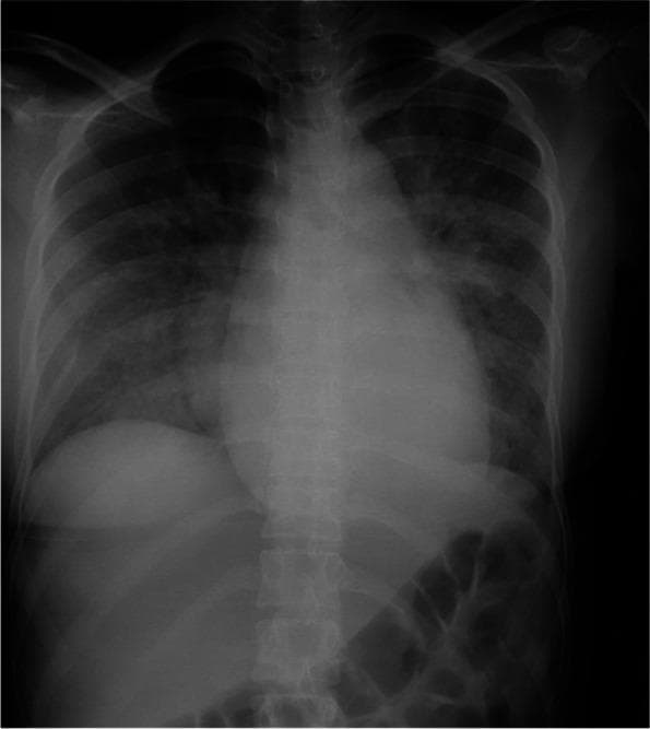 Anteroposterior (AP) chest radiograph demonstrating classic radiological signs of acute cardiogenic pulmonary edema in a pregnant patient. The cardiac silhouette is significantly enlarged, consistent with cardiomegaly. There is marked prominence and enhancement of the pulmonary vasculature, indicating venous congestion. The lung parenchyma shows diffuse, bilateral fluffy and patchy opacities, primarily distributed in a perihilar ('bat-wing') pattern, suggesting alveolar edema. The diaphragm is visible, and the skeletal structures, including the ribs and spine, are unremarkable. Clinically, this imaging correlates with acute heart failure, secondary to severe mitral regurgitation from infective endocarditis. The radiograph serves as a diagnostic tool for identifying pulmonary fluid overload and evaluating the severity of congestive heart failure in a critical obstetric and cardiovascular context.