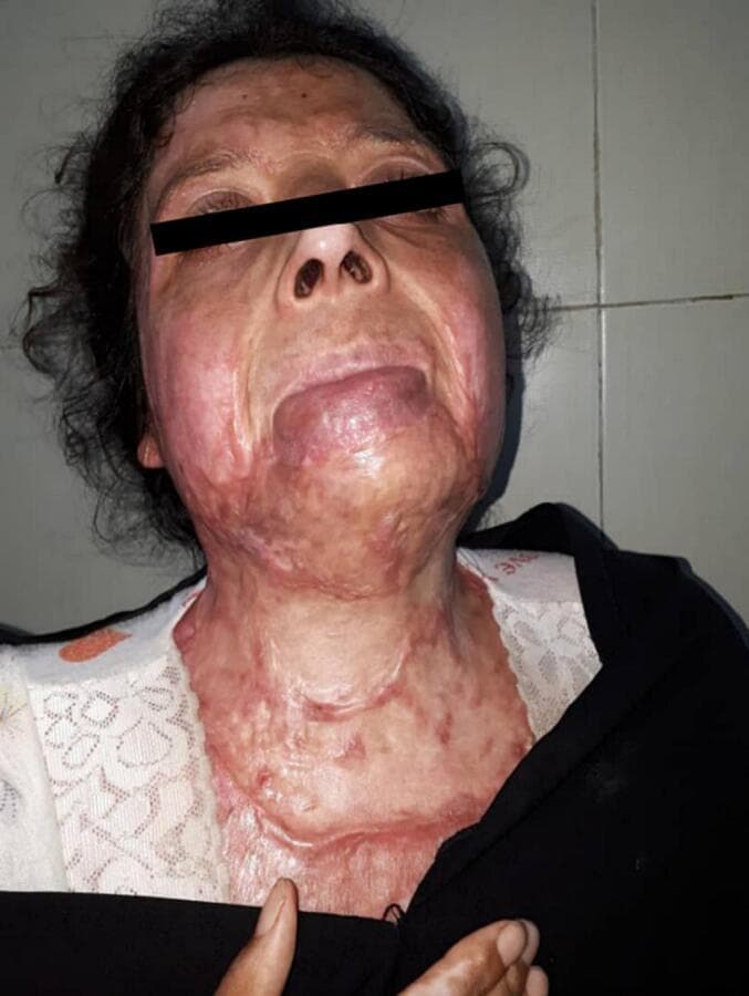 This clinical photograph shows a female patient's face, neck, and upper chest following treatment for extensive burn injuries and subsequent surgical reconstruction. The image illustrates post-operative healing and scarring. Widespread hypertrophic and atrophic scar tissue is visible, characterized by uneven texture, tautness, and a mixture of erythematous (pink-red) and hypopigmented (pale) patches. There is evidence of significant tissue remodeling across the mentum (chin), submental region, and the entire anterior neck. Structural distortions are present, including a downward pull of the lower lip and oral commissures, suggesting residual tension from scar contractures. The neck appears shortened with visible horizontal ridge-like formations, likely representing graft junctions or mature incision lines from a previous contracture release. The educational focus of this image is the long-term sequelae of severe thermal injuries, the outcomes of split-thickness skin grafting, and the role of physiotherapy in managing post-burn cervical contractures and improving functional range of motion.
