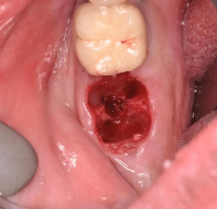 This clinical intraoral photograph displays a freshly prepared dental extraction site in the maxillary or mandibular arch, immediately following a tooth extraction performed with a piezotome. The extraction socket is prominently visible, characterized by its deep red color and irregular, multi-lobed morphology reflecting the previous root architecture. The interior of the socket shows evidence of early clot formation and exposed alveolar bone. The surrounding gingival tissue is pale pink with localized erythema and slight edema at the marginal edges, consistent with immediate post-operative inflammation. An adjacent, intact molar is visible distally or mesially to the surgical site, serving as an anatomical landmark. The surgical field is clean, indicating a controlled extraction procedure designed for immediate or delayed implant placement. This image is significant for demonstrating the minimally invasive nature of piezoelectric surgery in preserving the integrity of the buccal and lingual alveolar plates for subsequent implantology.