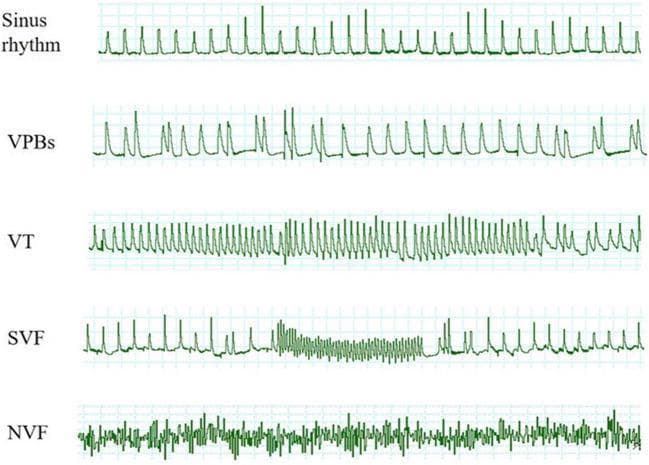 This diagnostic image displays a vertical sequence of five electrocardiogram (ECG) tracings illustrating the progression of ischemia/reperfusion-induced ventricular arrhythmias. 1. Sinus Rhythm: Shows a baseline regular rhythm with identifiable QRS complexes and T waves. 2. VPBs (Ventricular Premature Beats): Demonstrates intermittent, wide, and premature QRS complexes disrupting the regular sinus cadence. 3. VT (Ventricular Tachycardia): A rapid, monomorphic sequence of wide QRS complexes with no visible P waves, indicating a sustained tachyarrhythmia. 4. SVF (Spontaneous Ventricular Fibrillation): A chaotic, high-frequency oscillatory pattern that spontaneously terminates, transitioning back into a more organized, regular ventricular rhythm. 5. NVF (Non-terminated Ventricular Fibrillation): A continuous, irregular, and low-amplitude chaotic baseline with no discernible organized electrical activity or termination within the observation period. This comparison is used to study the severity and duration of malignant arrhythmias in clinical and experimental cardiology settings.