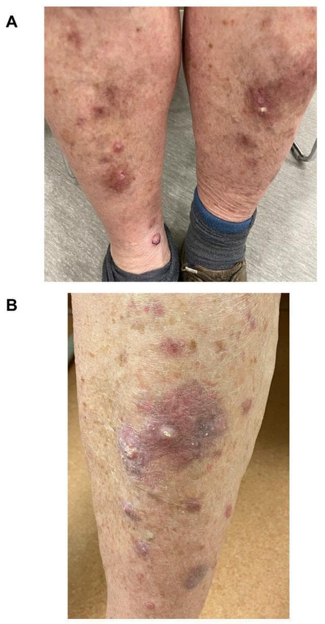 Clinical photograph of the bilateral lower limbs (Figure A) and a close-up detail (Figure B) demonstrating a cutaneous eruption characterized by violaceous papules and hypertrophic nodules. The lesions are distributed primarily over the shins and anterior surfaces of the lower legs. Individual lesions range from small, well-demarcated erythematous-to-violaceous papules to larger, indurated nodules with a rough, hyperkeratotic surface texture. Figure B shows a prominent violaceous plaque with central crusting and focal white scaling, suggestive of pseudoepitheliomatous hyperplasia or lichenoid dermatitis. The surrounding skin exhibits signs of chronological aging with mild diffuse erythema and mottled hyperpigmentation. This presentation is clinically representative of hypertrophic lichen planus, specifically appearing as a cutaneous immune-related adverse event (irAE) following immune checkpoint inhibitor therapy.