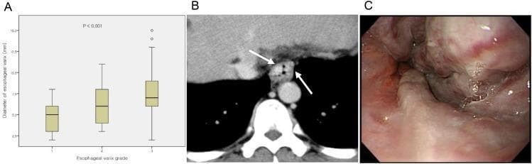 This composite image illustrates the correlation between diagnostic imaging and endoscopic findings for esophageal varices in a patient with liver cirrhosis. Panel A is a box plot showing a statistically significant positive correlation (p < 0.001) between endoscopic grading and the CT-measured diameter (mm) of esophageal varices. Panel B is an axial portal-phase CT scan demonstrating the distal esophagus with multiple nodular, hyper-enhancing, intraluminally protruding lesions (indicated by arrows), representing large esophageal varices measuring up to 10.7 mm. Panel C is an endoscopic view of the same patient, revealing multiple, tortuous, and congested large-caliber varices that cause significant distortion of the esophageal lumen. Reddish hues and surface congestion are visible, indicating high-risk features for hemorrhage. The content serves as a comparison between non-invasive radiological assessment (CT) and direct visualization (endoscopy) for managing portal hypertension complications.