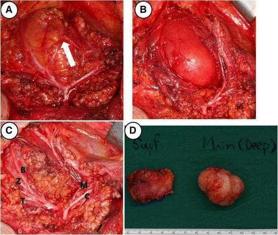 This composite of four clinical photographs illustrates intraoperative findings and gross pathology from a right parotidectomy for a deep-lobe tumor. Panel A shows the surgical field with a white arrow indicating a communicating nerve branch between the marginal mandibular and buccal branches of the facial nerve. Panel B demonstrates the tumor's location within the deep lobe of the parotid gland, adjacent to the masseter muscle. Panel C provides a comprehensive view of the preserved facial nerve branches following dissection, labeled as temporal (T), zygomatic (Z), buccal (B), marginal mandibular (M), and cervical (C). Panel D presents the gross surgical specimens against a green background with a metric scale; it differentiates the irregular superficial lobe parotid tissue ('Supf.') from the main, well-demarcated, multi-lobulated tumor mass ('Main (Deep)'). These images serve as educational material for head and neck surgery, specifically illustrating parotid gland anatomy, facial nerve preservation techniques, and surgical management of parotid neoplasms.