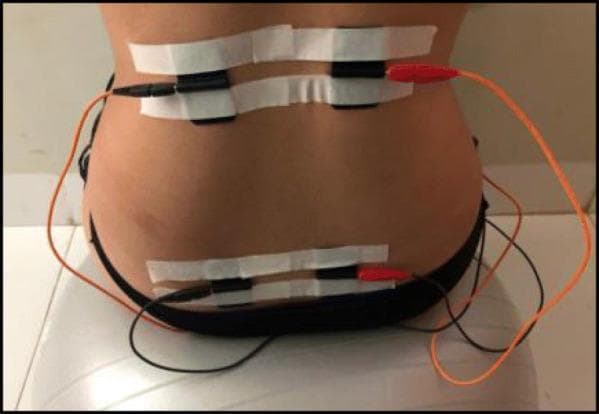 Clinical photograph demonstrating the electrode placement for Transcutaneous Electrical Nerve Stimulation (TENS) on the posterior trunk of a patient. Four black silicone electrodes are arranged in two horizontal pairs: a superior pair located in the thoracolumbar region (approximately T10–L1) and an inferior pair located in the sacral region (approximately S2–S4). The electrodes are secured to the skin using horizontal strips of white medical masking tape. Electrical leads are attached to each electrode, featuring a combination of black and orange wires that connect to a portable electrostimulation unit. This setup is typical for obstetric or physiotherapeutic pain management protocols, where the placement targets dermatomes associated with pelvic and lower back pain. The patient is shown in a seated position, likely on a therapeutic ball, consistent with labor pain management or pelvic floor rehabilitation settings.