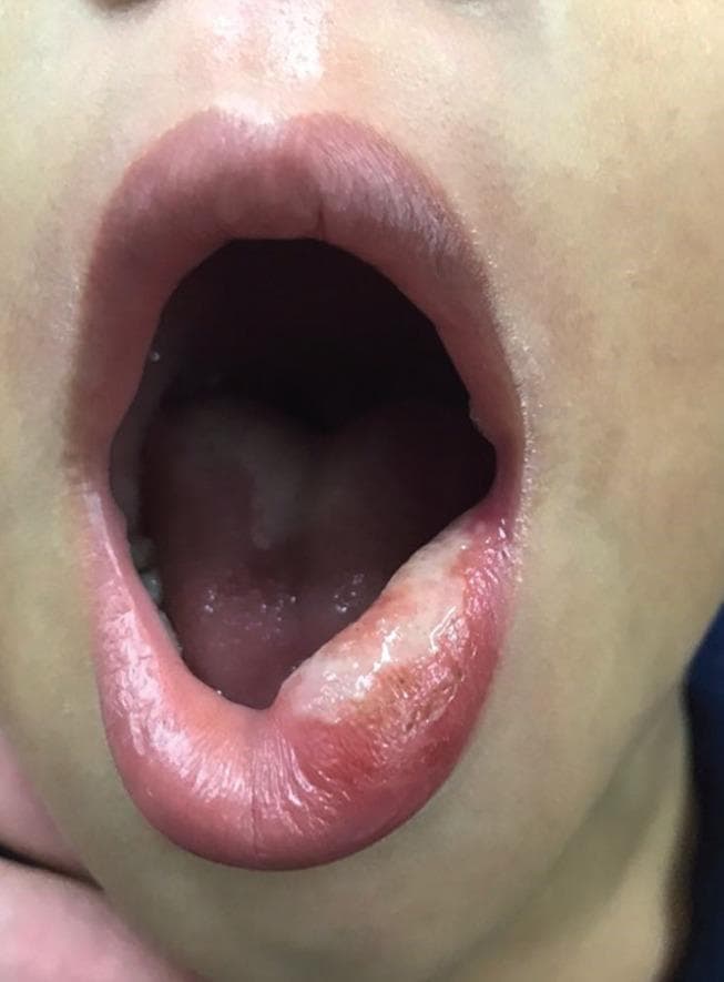 This clinical photograph displays a large traumatic ulcer located on the left side of the lower lip in a pediatric patient. The lesion is characterized by a prominent, irregularly shaped whitish-yellow fibrinopurulent plaque covering the mucosal and vermilion surface. The surrounding tissue exhibits significant erythema and edema, indicating an active inflammatory response. The ulceration appears localized to the area of mechanical trauma (lip-biting), with the adjacent upper lip and intraoral mucosa appearing healthy and pink. This image serves as a clinical example of post-anesthetic lip-biting, a common complication in pediatric dentistry. It is an educational tool for identifying traumatic oral lesions and understanding the clinical presentation of secondary pseudomembranous formation during the healing phase.