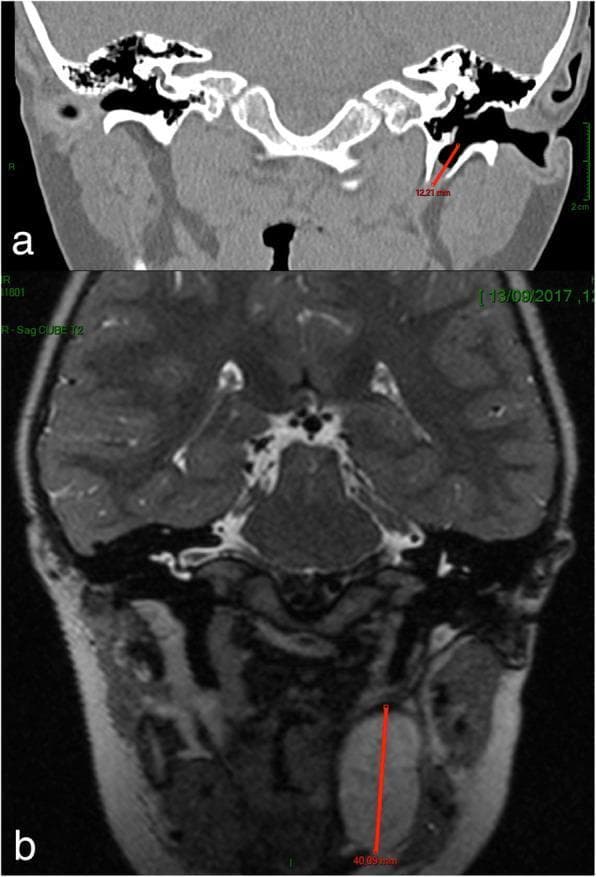 This dual-panel diagnostic image presents clinical imaging of the head and neck, specifically evaluating a suspected first branchial cleft cyst. Image (a) is a coronal CT scan of the temporal bones and skull base, highlighting a congenital anomaly: a bony canal (fistulous tract) measuring approximately 12.21 mm. This canal is situated in the deep portion of the tympanic bone, medial to the facial nerve and originating from the pre-tympanic region of the external auditory canal. Image (b) is a coronal T2-weighted MRI scan of the same patient, revealing a large, hyperintense, well-circumscribed parapharyngeal cyst in the left peri-tonsillar region. The cyst measures approximately 40.09 mm in its craniocaudal dimension. Together, these images illustrate the characteristic multi-component presentation of branchial cleft anomalies, involving both a cartilaginous/bony tract near the ear and a deeper soft tissue cystic component in the parapharyngeal space. The imaging modality and precise measurements are essential for pre-operative planning in otolaryngology to avoid injury to the adjacent facial nerve and carotid vasculature.