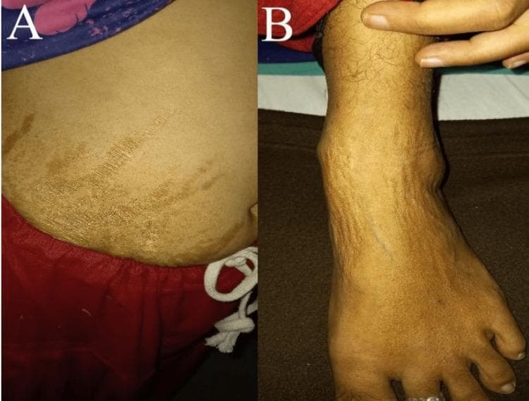 This composite clinical photograph displays dermatological manifestations in a 30-year-old patient with Systemic Lupus Erythematosus (SLE) and Lupus Nephritis (LN). Panel A illustrates the lower abdominal region, showing a series of hyperpigmented, linear striae-like lesions. These markings are irregularly distributed and appear as darker, brownish striations against the surrounding skin, characteristic of atrophic changes or medication-induced striae (often associated with chronic corticosteroid use). Panel B focuses on the anterior aspect of the left lower limb and ankle joint. It reveals significant localized edema (swelling) around the ankle and dorsal foot, accompanied by diffuse cutaneous hyperpigmentation and potentially livedo-like vascular changes. The clinical significance of these images lies in demonstrating the multi-organ involvement of SLE, highlighting both primary skin pathology and secondary changes related to chronic disease management or renal dysfunction (LN). This educational material is intended for clinical training in rheumatology, dermatology, and nephrology.