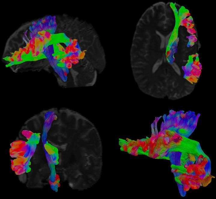 This diagnostic image displays Diffusion Tensor Imaging (DTI) tractography of the human brain across four views: sagittal, axial, coronal, and a 3D oblique reconstruction. The visualization uses a standard RGB color-coding system to represent the orientation of white matter fiber bundles: red for left-right, green for anterior-posterior, and blue for superior-inferior directions. The image specifically highlights major white matter tracts, including the anterior thalamic radiation (depicted in blue/purple tones in the context of connectivity) and the corticospinal tract. The tracts are shown as reconstructed 3D streamlines superimposed on grayscale anatomical MRI backgrounds. This educational content illustrates neuroanatomy and connectivity, specifically focusing on how geometric features of tracts, such as thickness and length, correlate with clinical psychological symptoms like somatization and anxiety. The dense, fiber-like structures demonstrate the complex spatial arrangement of the internal capsule and various radiations connecting the thalamus to the cerebral cortex and brainstem.