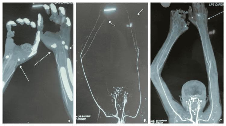 This diagnostic visual consists of three CT angiography (CTA) panels (A, B, and C) depicting the upper extremities of a patient with vascular insufficiency. Panel A focuses on the hands and distal forearms, demonstrating significant bilateral pathology characterized by poor contrast opacification of the palmar arches and digital arteries. The digital vessels appear attenuated, thinned, and interrupted, correlating with clinical findings of distal ischemia or gangrene. Panels B and C provide a more proximal view of the upper limb arterial tree, highlighting the bilateral ulnar and radial arteries. Arrows indicate critical stenoses and areas of diminished flow within the distal ulnar arteries bilaterally. The overall vascular morphology shows threadlike narrowing of distal vessels compared to more proximal arterial segments. These findings are consistent with thromboangiitis obliterans (Buerger's disease) or other severe peripheral arterial diseases, demonstrating a transition from patent proximal vessels to occluded or severely stenotic distal vasculature.