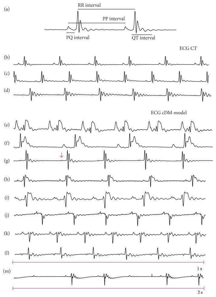 This diagnostic image displays multiple electrocardiogram (ECG) rhythm strips comparing control conditions (ECG CT) with a chronic diabetes mellitus model (ECG cDM-model). Panel (a) provides a reference anatomical diagram of ECG intervals, including the PQ, RR, PP, and QT intervals. Panels (b-d) show normal sinus rhythms from control subjects, characterized by regular P waves, standard QRS complexes, and consistent intervals. Panels (e-m) illustrate various pathological arrhythmias and morphological abnormalities associated with the cDM model. Key findings include: ST-segment elevation (e, g, h, i) suggesting myocardial injury or ischemia; QRS complex depression or inversion (j, k); supraventricular abnormalities such as an inverted P-wave (l) and a notched P-wave (indicated by a red arrow in g); and a second-degree atrioventricular (AV) block (m) characterized by non-conducted P waves and a slow, irregular rhythm. The recordings highlight the clinical significance of diabetic cardiomyopathy and its impact on cardiac electrical conduction and ventricular repolarization.