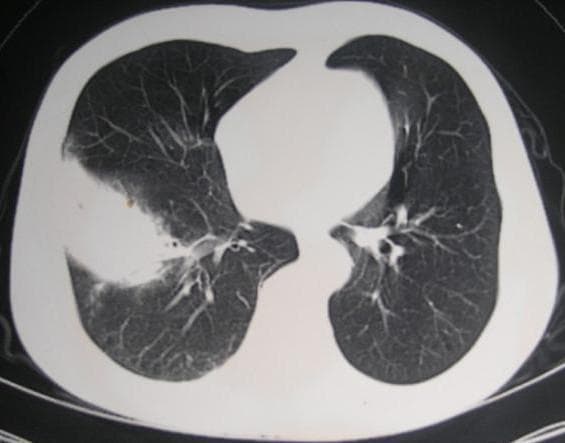 This diagnostic axial CT scan of the thorax, using a lung window, demonstrates classic features of lobar pneumonia. The primary finding is a large, dense area of consolidation localized to the lower lobe of the right lung. This consolidated region presents as a homogenous soft-tissue density that obscures the normal lung parenchyma and vascular markings, characteristic of alveolar fluid or exudate accumulation (pathologically corresponding to the stage of gray hepatization). In contrast, the left lung appears normal, displaying clear aeration with well-defined branching vascular and bronchial structures. The mediastinal structures are centered, and no pleural effusions are immediately visible in this section. This image serves as a clinical example of pulmonary consolidation, highlighting the visual distinction between healthy air-filled lung tissue and pathological density caused by an infectious process like lobar pneumonia.