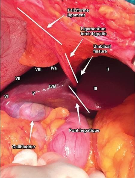 An intraoperative clinical photograph providing a detailed view of the liver surface and its anatomical segments according to the Couinaud classification. The image demonstrates the spatial relationships of the falciform ligament and ligamentum teres hepatis as they approach the umbilical fissure, effectively dividing the left lobe (segments II and III) from the right and middle sections (segments IVa, IVb, and VIII). The gallbladder is clearly visualized as a distended, bluish-gray sac positioned inferior to segments V and VI. Adjacent to the gallbladder, the pont hepatique (hepatic bridge) is identified as a parenchymal bridge of liver tissue connecting the medial and lateral segments. Roman numeral labels highlight the specific liver segments (II, III, IVa, IVb, V, VI, VII, VIII), aiding in the surgical localization of landmarks. This laparoscopic or open surgical view is essential for understanding hepatic anatomy during cholecystectomy or segmental liver resection.
