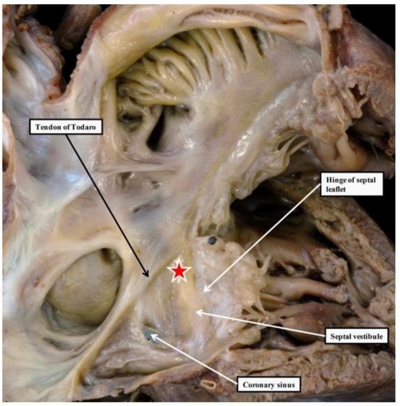 This clinical photograph displays a gross anatomical dissection of an opened human right atrium, focusing on the surgical and electrophysiological landmarks of the triangle of Koch. Key structures are labeled to demonstrate the anatomical boundaries relevant to the cardiac conduction system. The Tendon of Todaro is identified as a fibrous band forming the superior border, while the hinge of the septal leaflet of the tricuspid valve forms the inferior-lateral boundary. The coronary sinus ostium is visible at the base. A red star marks the apex of the triangle, indicating the precise location of the atrioventricular (AV) node. The septal vestibule is also highlighted, showing its relationship to the AV node and the surrounding myocardial tissue. This visual serves as a critical educational resource for understanding cardiac anatomy, specifically for procedures involving the AV node, such as catheter ablation or pacemaker lead placement. The image illustrates the transition from atrial tissue to the penetrating bundle of His within the central fibrous body.