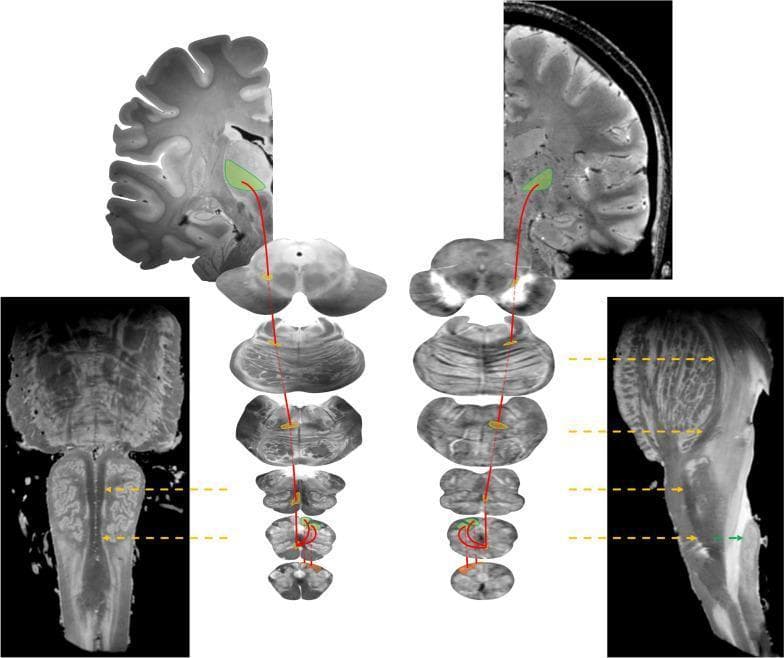 Educational neuroanatomical diagram and MRI composite illustrating the dorsal column-medial lemniscus (DCML) system. The visual uses a side-by-side comparison of ex vivo (left) and in vivo (right) high-resolution 7-T MR images to trace the somatosensory pathway. Red lines represent the trajectory of second-order neurons from the brainstem to the thalamus. Key structures are color-coded: the gracile and cuneate fasciculi are highlighted in orange at the caudal medulla; the gracile and cuneate nuclei are in green, marking the site of first-order synapse. The internal arcuate fibers are shown decussating before forming the medial lemniscus, which is highlighted in yellow across axial slices of the medulla, pons, and midbrain. Yellow arrows in the oblique sagittal and coronal brainstem views indicate the ascending trajectory of the medial lemniscus. The pathway terminates at the ventral posterolateral (VPL) nucleus of the thalamus, highlighted in green on coronal sections. This infographic serves as a diagnostic and anatomical reference for tracing epicritic sensation and conscious proprioception pathways.