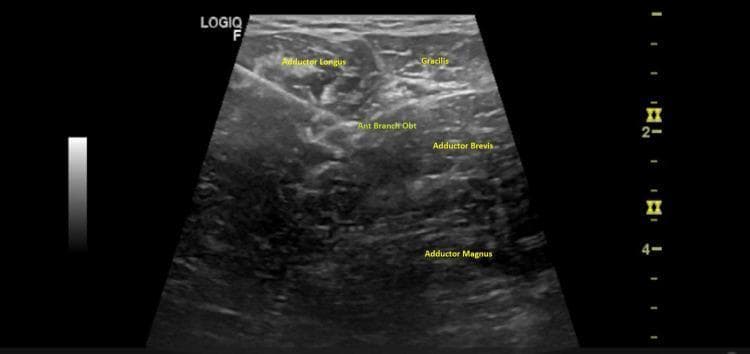 This diagnostic ultrasound image demonstrates a cross-sectional view of the medial thigh musculature and neural anatomy, specifically highlighting a regional anesthesia or interventional pain procedure. The image depicts the fascial planes between the adductor longus, gracilis, and adductor brevis muscles. The anterior branch of the obturator nerve (Ant Branch Obt) is identified as a hyperechoic structure situated in the interfascial plane between the adductor longus and adductor brevis. Deep to these structures lies the adductor magnus. A hyperechoic linear structure representing an interventional needle is visible, traversing through the adductor longus with its tip precisely positioned in the fascial plane adjacent to the anterior branch of the obturator nerve. This visual serves as a guide for performing an obturator nerve block, frequently used for hip surgery analgesia or treating adductor spasticity. The educational focus is on the sonoanatomy of the thigh's medial compartment and the 'in-plane' needle technique for peripheral nerve blocks.