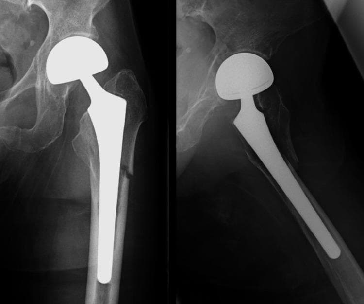 Anteroposterior and lateral radiographs of the left hip and proximal femur demonstrate a periprosthetic femoral fracture (PFF) around an existing bipolar hemiarthroplasty (BHA). The prosthesis consists of a metallic femoral stem and a modular, large-diameter femoral head articulating within the native acetabulum. A transverse, minimally displaced fracture is located mid-stem at the femoral diaphysis, consistent with a Vancouver Type B1 classification. This classification implies that the prosthetic stem remains well-fixed despite the surrounding fracture. The femoral cortex shows signs of thinning, suggesting underlying osteopenia or osteoporosis. No significant comminution, periosteal reaction, or implant subsidence is visible. This imaging is characteristic of geriatric orthopedic trauma involving existing joint replacements, requiring surgical stabilization while preserving the stable implant.
