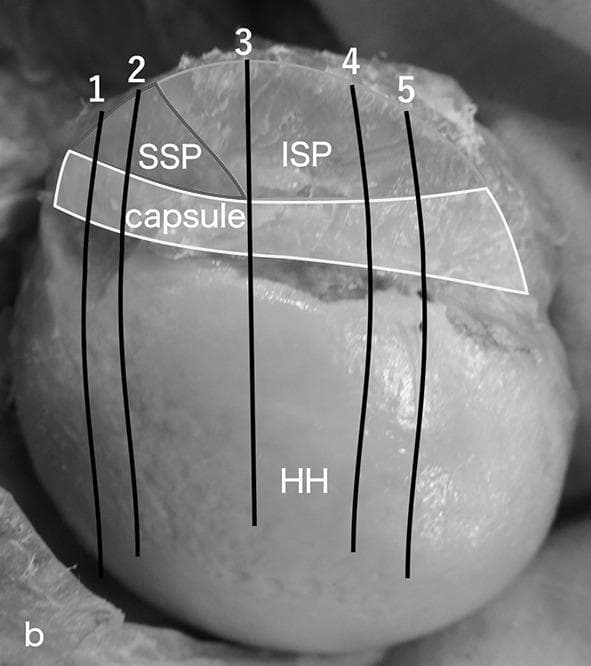 This medical anatomical diagram and clinical photograph illustrate the spatial relationships and histological sectioning planes of the rotator cuff complex. The image shows a superior and lateral view of the humeral head (HH) with the overlying glenohumeral joint capsule and associated tendons. The supraspinatus (SSP) and infraspinatus (ISP) tendons are clearly demarcated, with the capsule positioned deep to these musculotendinous structures. Five vertical black lines (labeled 1–5) indicate the orientations of coronal sections used for microscopic observation. Lines 1 and 2 correspond to the anterior and posterior regions of the supraspinatus tendon, respectively. Lines 3, 4, and 5 represent the superior, middle, and inferior partitions of the infraspinatus tendon. This visual is designed to demonstrate the integrated anatomy of the rotator cuff attachment site (footprint) and the specific sub-regions of the tendons relative to the joint capsule, serving as a guide for orthopedic pathology or anatomical study of shoulder biomechanics.