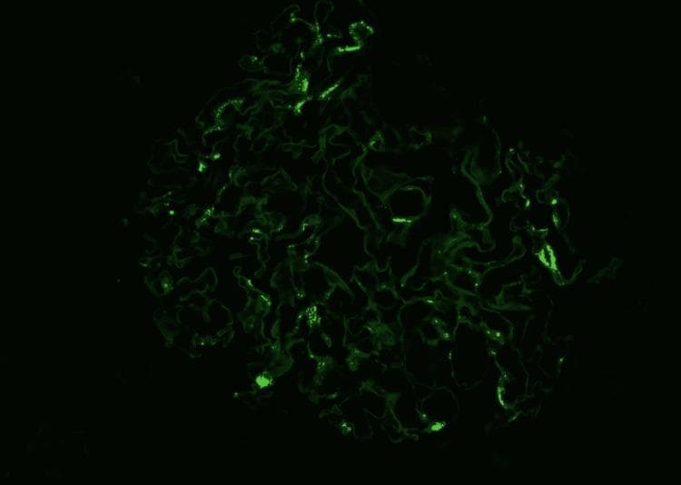 This diagnostic immunofluorescence image demonstrates a renal glomerulus exhibiting a characteristic staining pattern for IgA nephropathy. Against a dark background, a bright green fluorescent signal is localized primarily within the mesangial regions. The signal presents as granular, irregular deposits concentrated in the mesangial matrix, reflecting the entrapment of immunoglobulin A (IgA) immune complexes. The overall structure of the glomerulus shows a complex, lobulated architecture with visible capillary loops. While some areas demonstrate intense, discrete granular fluorescence, others show a more diffuse or attenuated signal, which may correlate with underlying morphological changes such as mesangial hypercellularity or segmental sclerosis. This imaging modality is essential in nephropathology for differentiating between various forms of glomerulonephritis based on the specific distribution (mesangial vs. capillary wall) and nature (granular vs. linear) of immune deposits.