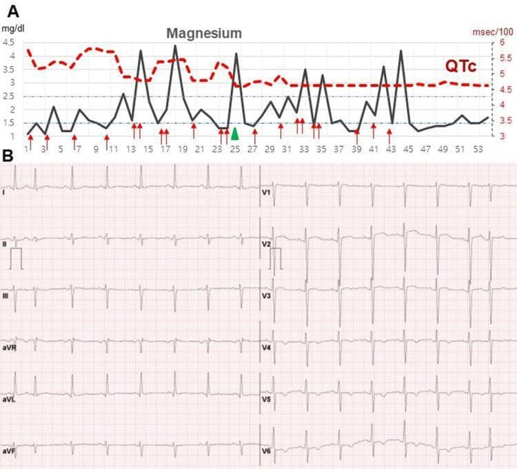 This composite educational graphic consists of two panels focusing on the clinical management of electrolyte imbalances and their cardiac manifestations. Panel A is a dual-axis timeline graph illustrating the longitudinal relationship between serum magnesium levels and the corrected QT interval (QTc). The x-axis tracks time in days (up to day 53). The left y-axis measures serum magnesium (mg/dL, black solid line), showing fluctuations often below the reference range (1.5-2.7 mg/dL). The right y-axis measures the QTc interval (msec/100, red dashed line). Red arrows indicate points of intravenous magnesium supplementation, and a green triangle marks the initiation of vitamin D supplementation, which correlates with the eventual stabilization of magnesium levels and normalization of the QTc interval. Panel B displays a standard 12-lead electrocardiogram (ECG) captured one month after discharge. It shows a normal sinus rhythm with regular P waves, QRS complexes, and T waves. The precordial leads (V1-V6) demonstrate appropriate R-wave progression. This figure illustrates the pathophysiology of secondary long QT syndrome due to refractory hypomagnesemia and the clinical impact of corrective biochemical interventions on cardiac repolarization.