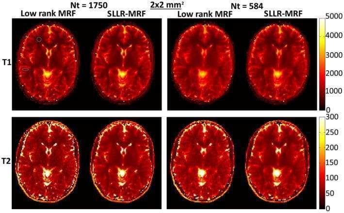 This diagnostic comparison chart displays axial in vivo brain parametric maps (T1 and T2 relaxation times) at 2x2 mm² resolution, comparing two Magnetic Resonance Fingerprinting (MRF) reconstruction techniques: standard Low-rank MRF and the proposed SLLR-MRF. The top row shows T1 maps with a color scale ranging from 0 to 5000 ms, while the bottom row shows T2 maps scaled from 0 to 300 ms. The images are categorized by data acquisition length: Nt=1750 and Nt=584 time-points. Key visual findings include residual blurring in the T1 maps and significant noise amplification in the T2 maps when using standard Low-rank MRF at the lower sampling rate (Nt=584). In contrast, SLLR-MRF demonstrates superior image fidelity and noise suppression, maintaining map quality despite the reduction in data. Dotted circles on the T1 images indicate regions of interest (ROI) for gray and white matter quantitative analysis. This figure illustrates advancements in quantitative MRI acceleration through structured low-rank and sparse reconstruction algorithms.