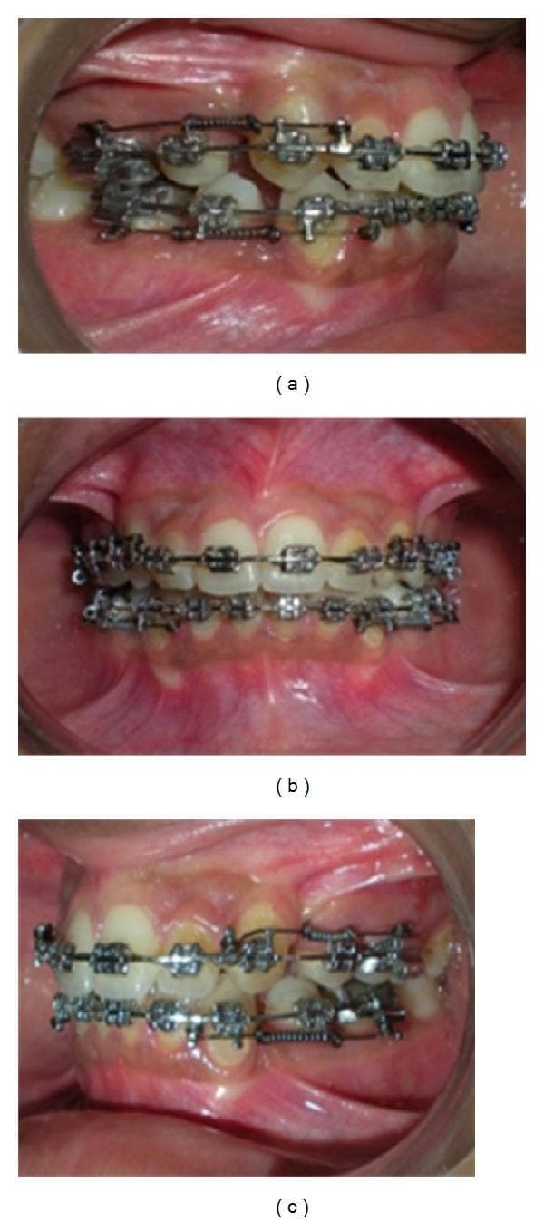 This composite of three intraoral clinical photographs (labeled a, b, and c) illustrates the progression of extraction space closure in a patient undergoing orthodontic treatment. The images show both maxillary and mandibular arches fitted with fixed orthodontic appliances, including metal brackets, a continuous stainless steel archwire, and specialized open-coil retraction springs (OCRS). The OCRS is positioned along the archwire, spanning the extraction gaps. In the initial stage (a), the extraction spaces are wide, and the OCRS is stretched and activated. As treatment progresses through (b) and (c), the extraction spaces visibly narrow as the anterior teeth are retracted and the posterior teeth mesially migrate. The OCRS decompresses accordingly; the spring coils appear less stretched and the overall distance between the engaging hooks (attached to the archwire anteriorly and molar hooks posteriorly) decreases. These images demonstrate the clinical application of sliding mechanics for 'en-masse' retraction of anterior teeth following premolar extractions.