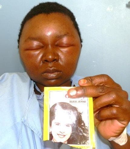 This clinical photograph displays a frontal view of a 29-year-old female patient with severe, generalized facial angioedema. The primary pathological finding is marked periorbital edema, resulting in complete involuntary closure of both eyes due to eyelid swelling. The edema extends across the forehead, malar regions, and lower face, causing a loss of normal anatomical contours and a tense, shiny appearance to the skin. The patient is holding a commercial hair dye packet labeled 'BLACK HENNA', identifying the likely allergen as paraphenylenediamine (PPD). This image illustrates a severe case of allergic contact dermatitis with secondary systemic manifestations following the use of topical hair dye. The clinical presentation is critical for differential diagnosis against orbital cellulitis or idiopathic angioedema. This visual serves as an educational tool for dermatology and emergency medicine regarding type IV hypersensitivity reactions and the risks associated with chemical additives in cosmetic products like PPD.