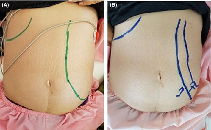 This side-by-side clinical photograph comparison illustrates the regression of massive splenomegaly in a patient with visceral leishmaniasis (kala-azar). Image A shows the patient's abdomen upon admission, displaying significant abdominal distension and striae. Green markings on the skin delineate the palpable borders of the grossly enlarged spleen, which extends from the left costal margin across the midline and deep into the left lower quadrant and pelvic region. Image B, captured one week after the initiation of treatment (Amphotericin B), shows a visible reduction in abdominal girth and more restricted blue markings that indicate the receding splenic margin. The comparison serves as a clinical demonstration of the physical examination findings associated with splenic sequestration and the rapid response to antiprotozoal therapy. The anatomical landmarks include the lower rib cage and iliac crests, used to track the decrease in organomegaly during the recovery phase of the disease.