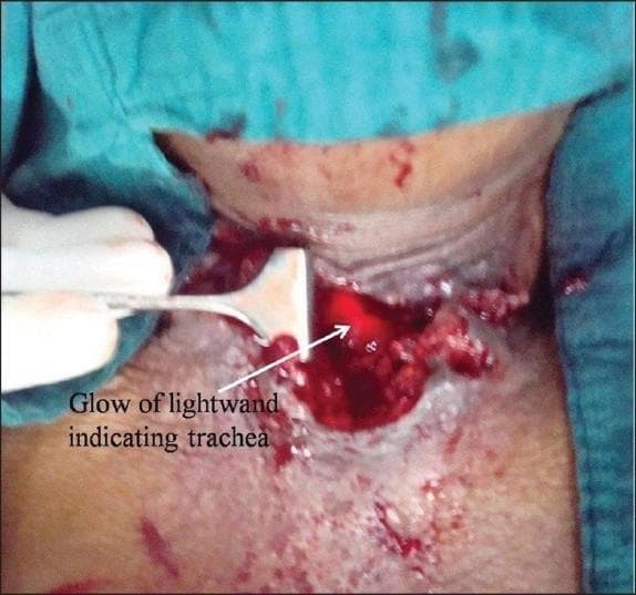Clinical photograph of an intraoperative field during a tracheostomy procedure on a human neck. The image displays an open surgical incision with visible tissue disruption, muscle layers, and moderate bleeding. A surgical retractor, held by a gloved hand, is used to manipulate and expose the deeper cervical structures. A distinctive feature is a bright red, localized transillumination glow emanating from the depth of the wound, labeled as the 'glow of lightwand indicating trachea.' This technique is being utilized to identify the anatomical location of the trachea in a patient with distorted neck anatomy due to underlying malignancy. The contrast between the intense red light and the surrounding dark, bloody tissue helps the surgical team orient the airway for tube placement or revision. This visual demonstrates an advanced airway management technique within surgical and critical care medicine, specifically for identifying the trachea when standard landmarks are obscured or displaced.