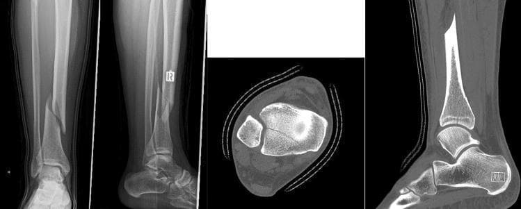 A composite medical diagnostic image including plain X-ray radiography (anteroposterior and lateral views) and Computed Tomography (CT) scans (axial and sagittal planes) of the lower leg and ankle. The imaging demonstrates a spiral fracture of the distal third of the tibial shaft (AO/OTA Type 42A1), characterized by a long, torsional fracture line with moderate displacement and an associated non-comminuted fibular fracture. Accompanying CT images reveal a concomitant posterior malleolus fracture (Volkmann's fragment) involving the articular surface of the distal tibia, which is often occult on initial plain films. The sagittal CT view highlights the longitudinal extent of the tibial shaft fracture and the posterior articular fragment, while the axial view confirms the intra-articular extension at the ankle joint. This case illustrates the high clinical incidence of posterior malleolus involvement in spiral tibial shaft fractures and emphasizes the educational value of CT for preoperative planning and screw osteosynthesis.