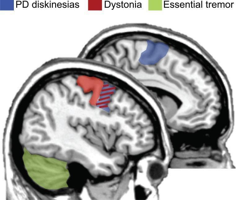 This medical diagram displays two sagittal brain slices, likely based on T1-weighted MRI or CT imaging, used to illustrate optimal neuroanatomical targets for repetitive transcranial magnetic stimulation (rTMS) in treating hyperkinetic movement disorders. The image employs a color-coded mapping system: blue highlights the premotor regions and supplementary motor area (SMA) as targets for Parkinson's Disease (PD) levodopa-induced dyskinesias; red highlights the primary motor and premotor cortices for dystonia; and green highlights the cerebellum as the preferred site for essential tremor. A red and blue striped overlay designates the premotor region as an overlapping therapeutic target for both dyskinesias and dystonia. The upper slice focuses on the superior cortical regions (SMA/premotor), while the lower slice demonstrates the spatial relationship between the motor cortex and the posterior-inferiorly located cerebellum. This visual resource serves as a clinical guide for neuromodulation protocols in neurology and neurosurgery, specifically addressing movement disorder pathophysiology.