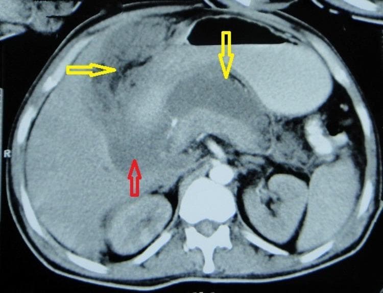 This diagnostic image is an axial Contrast-Enhanced Computed Tomography (CECT) scan of the upper abdomen at the level of the pancreas. The image demonstrates hallmark signs of acute pancreatitis, including focal and diffuse changes in glandular density and associated peripancreatic complications. The pancreatic head and uncinate process (marked by a red arrow) exhibit mild focal hypodensity, while the tail shows more pronounced hypodensity. Multiple peripancreatic fluid collections are visible. A vertical yellow arrow points to a significant collection in the lesser sac, which contains air specks (gas) in the non-dependent portion. A horizontal yellow arrow indicates an additional collection in the right subhepatic space containing mixed-density material, including fat and air specks. The presence of gas within these collections is highly suggestive of infected pancreatic necrosis or abscess formation. Key landmarks such as the liver, kidneys, aorta, and stomach are also visible in this cross-section. This scan is educationally significant for identifying CT severity markers in pancreatitis, including parenchymal necrosis (hypodensity) and the evolution of extrapancreatic fluid collections.