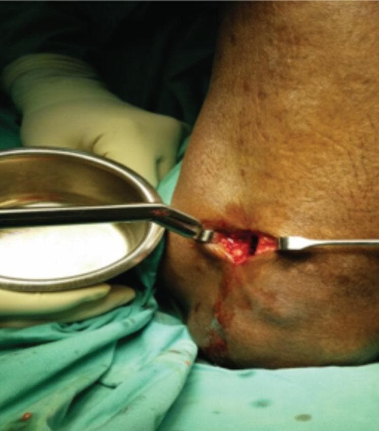 Clinical photograph illustrating an intraoperative stage of a proximal tibial bone graft harvest. The image shows a small, rectangular surgical incision on the medial aspect of the proximal tibia, approximately 2 cm below the tibial tuberosity. Within the open wound, the cortical bone window and cancellous bone are visible, with minor localized bleeding at the wound edges. A right-angled pituitary forceps is inserted into the osteotomy site to retrieve cancellous bone fragments. A periosteal elevator is positioned at the superior margin of the incision to maintain exposure. A sterile stainless steel bowl is held adjacent to the site by a gloved assistant to receive the harvested graft material. The procedure is performed under sterile conditions, indicated by green surgical drapes and latex-free surgical gloves. This visual demonstrates the medial approach for harvesting autologous bone graft from the tibia, highlighting relevant surgical instruments and anatomical landmarks for orthopedic surgery education.